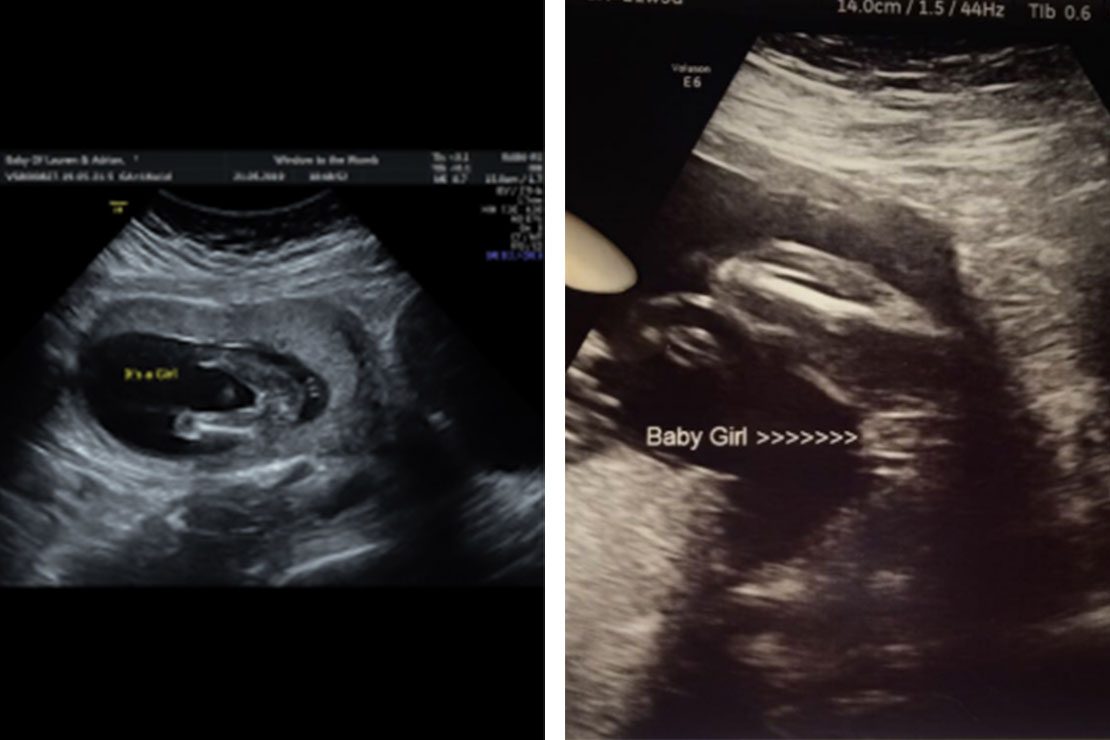 3 lines on pregnancy ultrasound: does it show your baby's sex? | MadeForMums