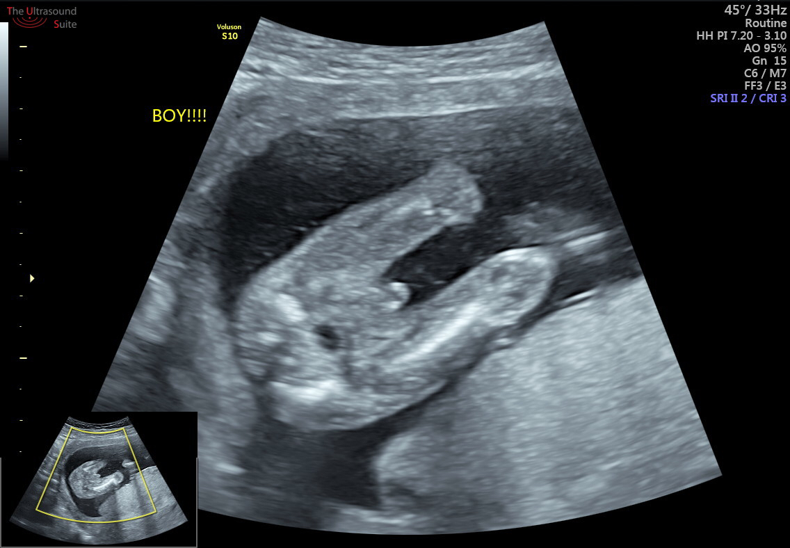 How Early Can I Find Out my Baby's Gender? -