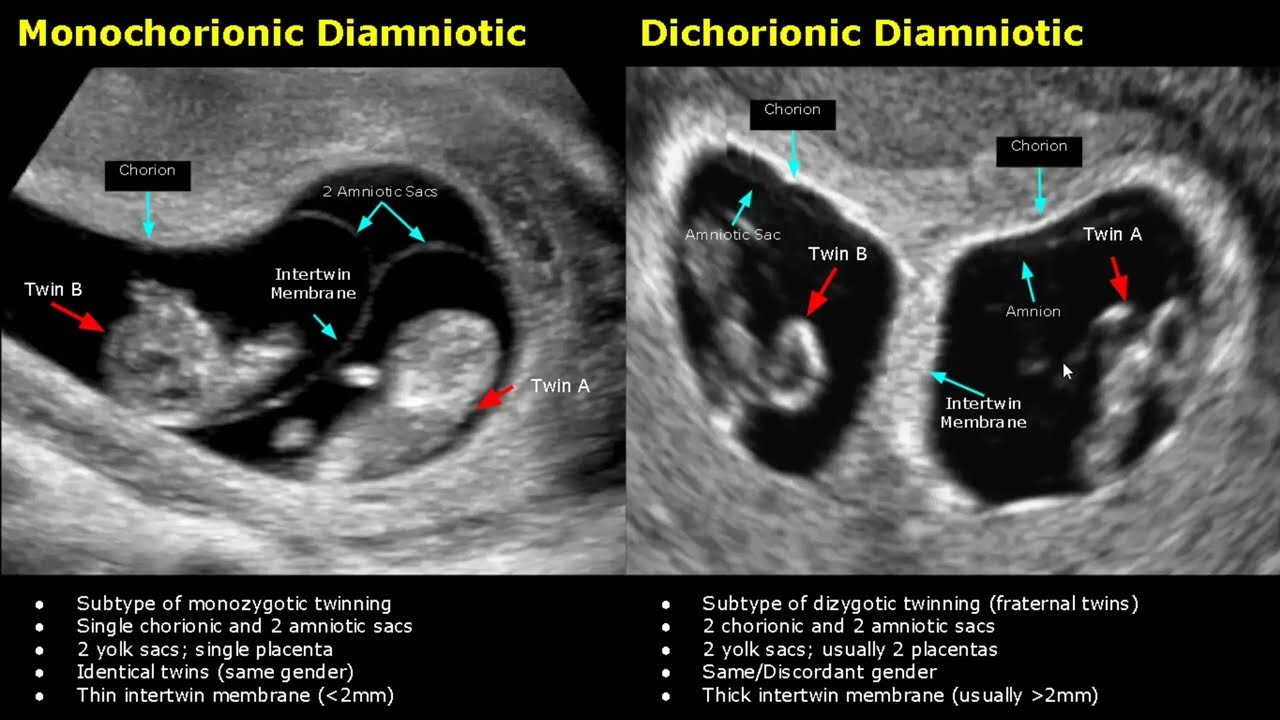 Fetal Twins Ultrasound Normal Vs Abnormal |  Monochorionic/Dichorionic/Diamniotic/Monoamniotic USG